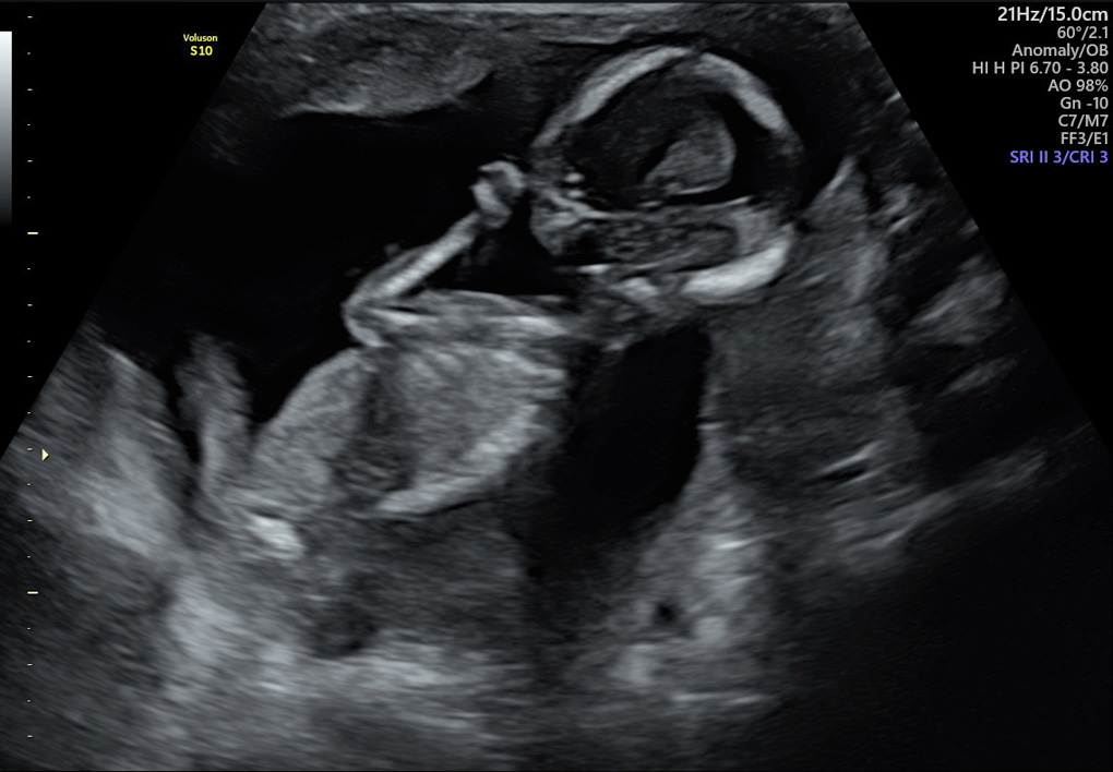 Ultrasound of a baby