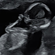 Ultrasound of a baby